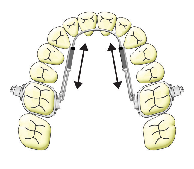 TransForce2 Sagittal Arch Developers